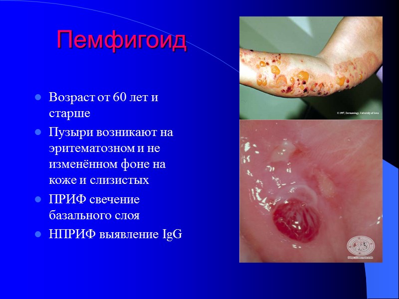 Пемфигоид Возраст от 60 лет и старше Пузыри возникают на эритематозном и не изменённом